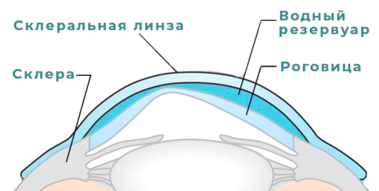 Склеральная линза